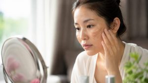 cách trị nám gò má tại nhà